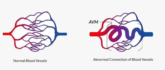 image of avm formation in brain in simple diagram form